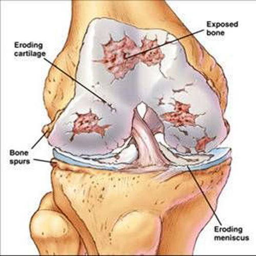 Bệnh thoái hóa khớp - Cty cổ phần thương mại và xuất nhập khẩu Aladin