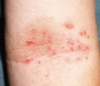 Eczema Atopic
