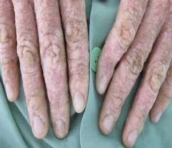 bien chung cua vay nen