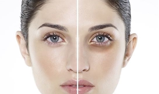 Bọng mắt? Nếp nhăn? Vùng mắt lão hóa - Giải pháp chống nhăn vùng mắt