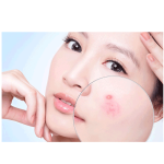 Kem trị mụn Dermalogica Special Clearing Booster tiêu diệt mụn khó nhằn