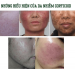 Lật mở nguyên nhân mặt nạ thải độc trở nên quan trọng với làn da??