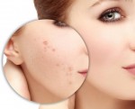 Trị thâm mụn bằng cách nào vừa an toàn vừa hiệu quả?