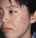 Có cách nào trị mụn hiệu quả ngay tại nhà mà không cần đến spa?