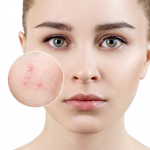 Top thực phẩm gây mụn hàng đầu, chị em nên tránh để có làn da mịn màng