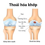 Cách giảm nhanh cơn đau do thoái hóa khớp gối chỉ bằng thực phẩm