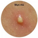 Bí quyết giảm sưng tấy và điều trị mụn mủ hiệu quả