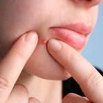Cảnh báo việc nặn mụn sai cách sẽ hình thành nên sẹo