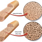 Để phòng chống loãng xương phải ăn những gì?