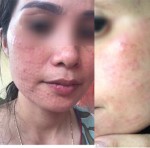 Tiêm collagen và những rủi ro bạn nên lường trước