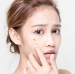 Những thành phần nào cần có trong sản phẩm trị thâm mụn?
