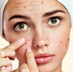 Những điều cần thực hiện đúng sau khi nặn mụn