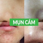 Trị mụn cám đơn giản từ các nguyên liệu đơn giản, dễ tìm