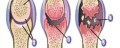 Thoái hóa khớp – căn bệnh phổ biến từ tuổi 35