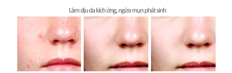 Kem trị mụn Dermalogica 
