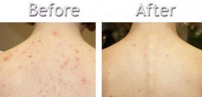 sữa tắm Murad Acne Body Wash