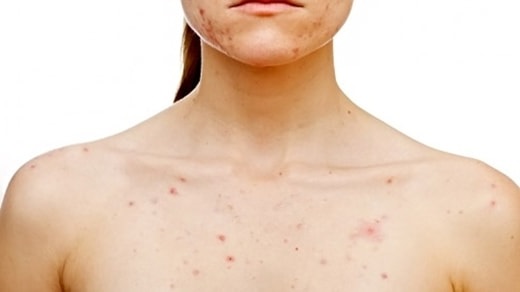 sữa tắm Murad Acne Body Wash