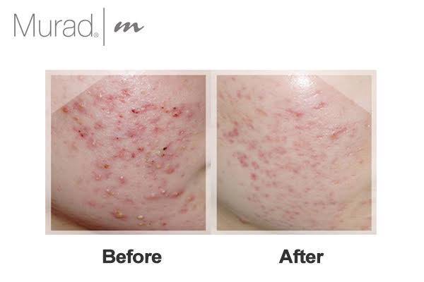 Kem trị mụn Murad Blemish Clearing Solution