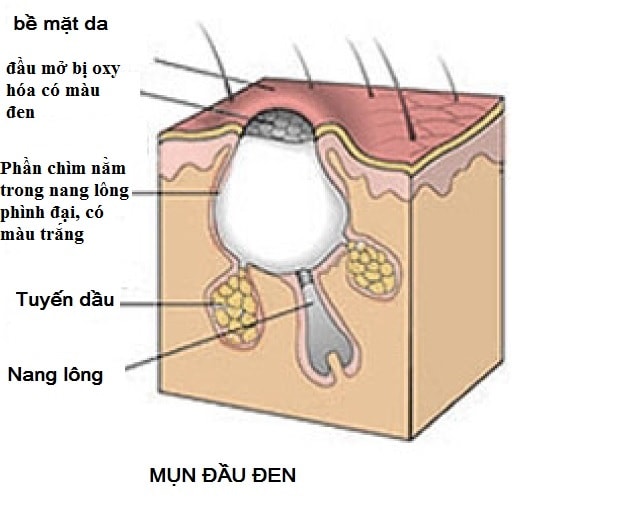 Chữa mụn đầu đen hiệu quả, giảm nhờn ở da nhờ Kem dưỡng ẩm Murad